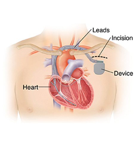 cardiac resynchronization therapy